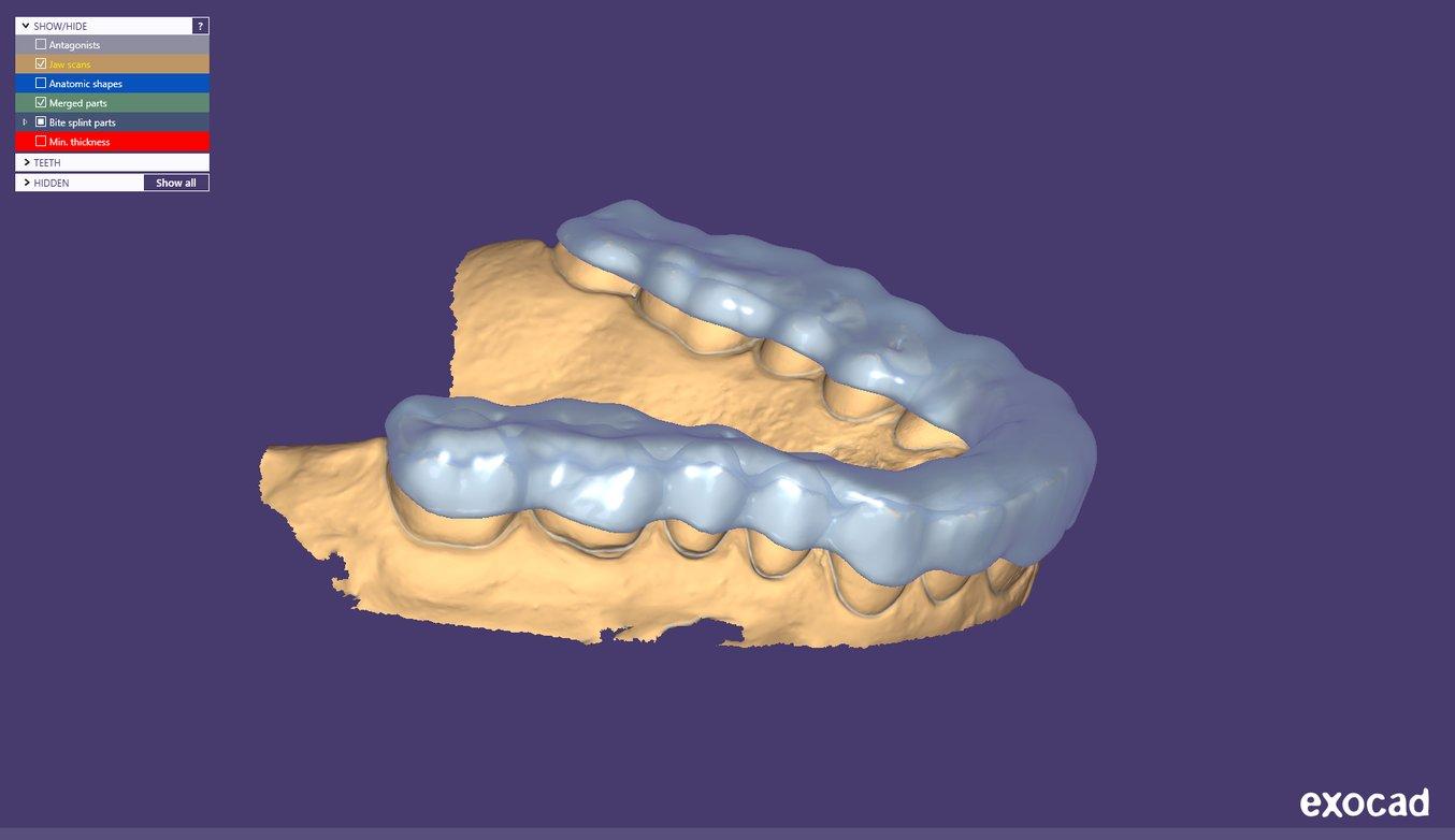 An occlusal splint being designed in exocad​​​​​​​.