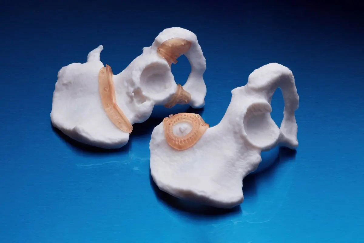 Two 3D printed white anatomical models with 3D printed translucent amber surgical guides
