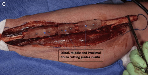 Distal middle and proximal fibula cutting