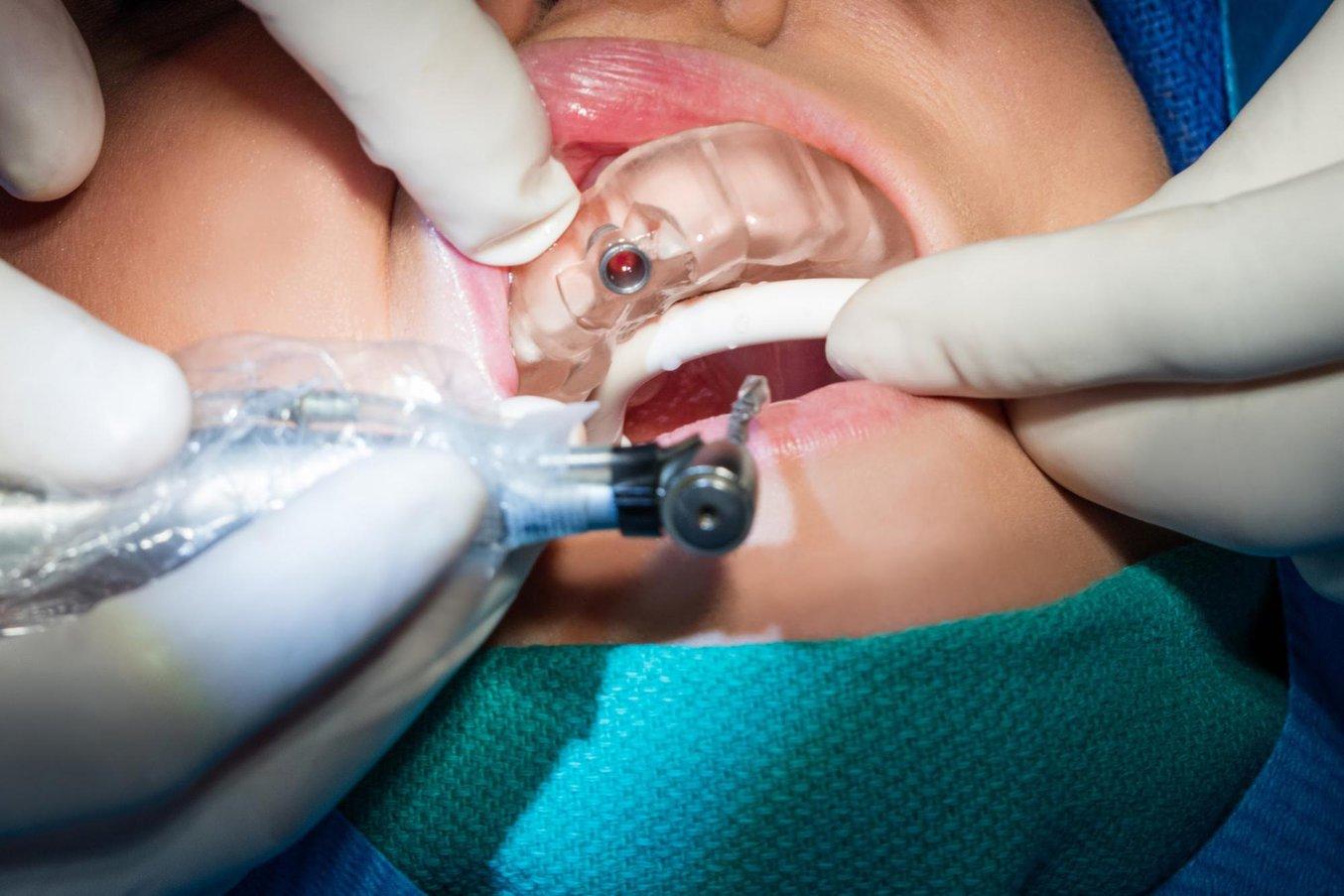 Using a surgical guide in a patient's mouth