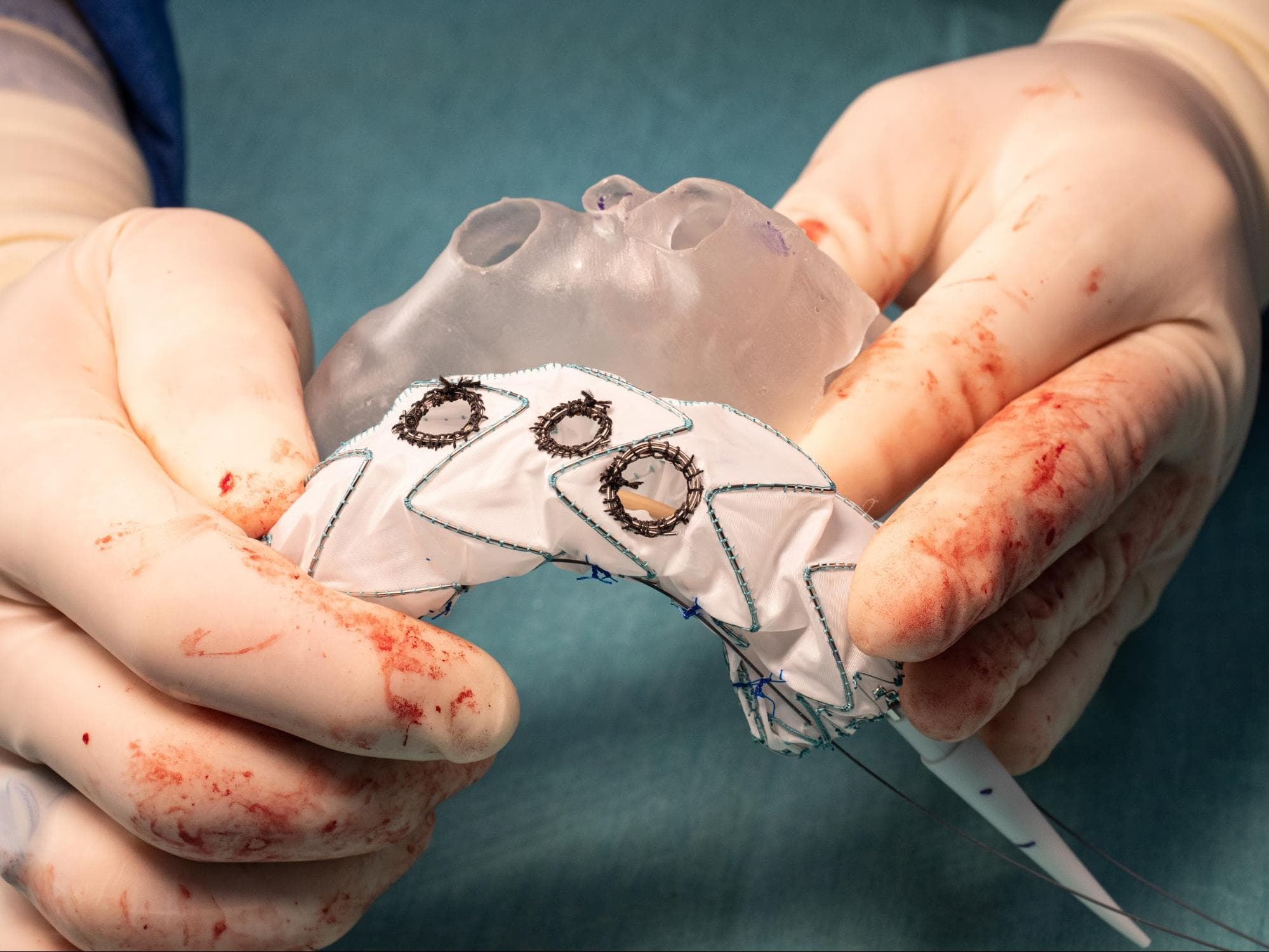 How 3D Printing Helps Save Patients With Aortic Aneurysms