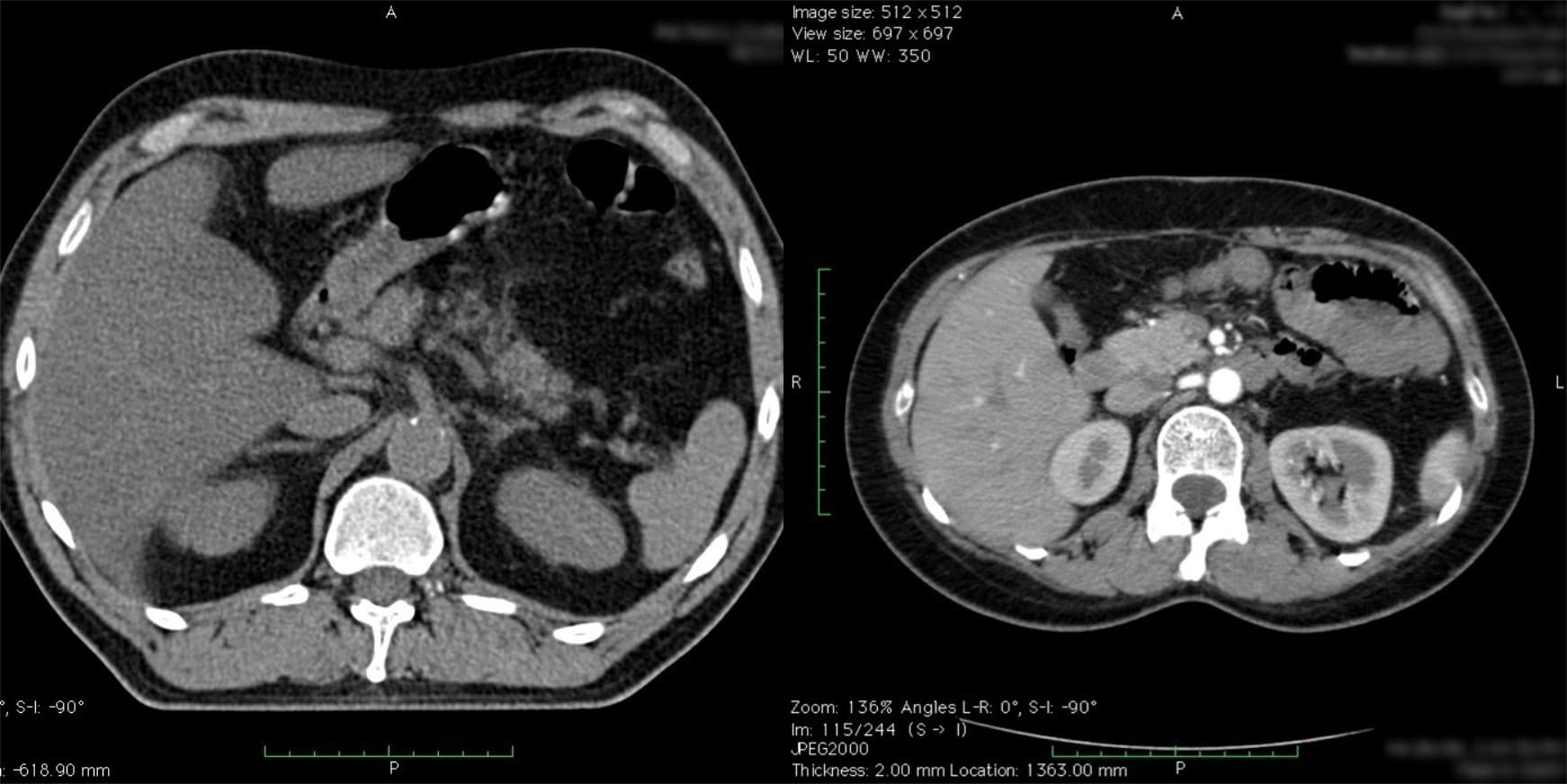 two axial (transverse) images of CT scans of the upper abdomen