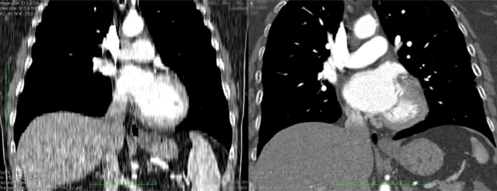 two CT scans of the chest