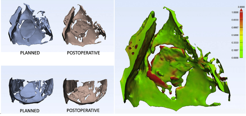 Comparison of planned and achieved orbital floor reconstruction