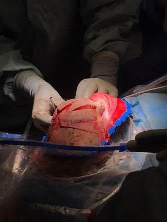 Ein Schädel und eine chirurgische Schnittschablone, die bei der Operation verwendet wird