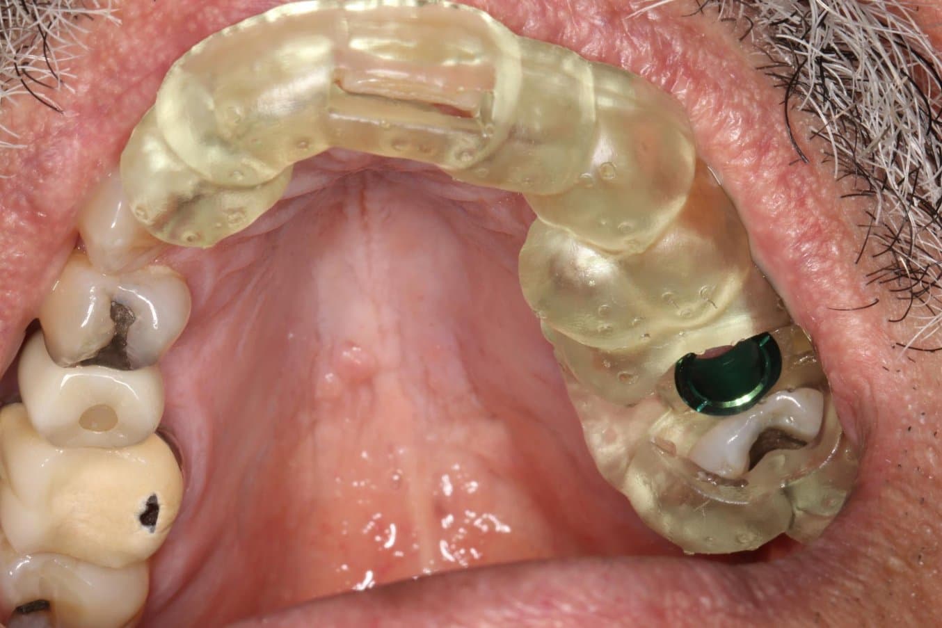 La Surgical Guide Resin es la primera resina biocompatible desarrollada y fabricada por Formlabs para producir guías quirúrgicas para implantes de la mejor calidad.