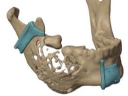 3d model of ameloblastoma surgery