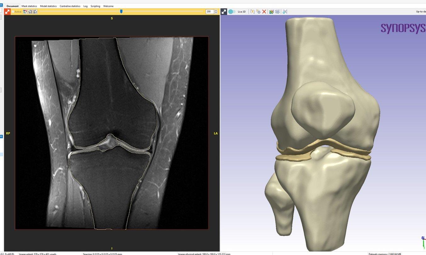 Side by side image of a joint with tissue and a 3D model of the corresponding bones