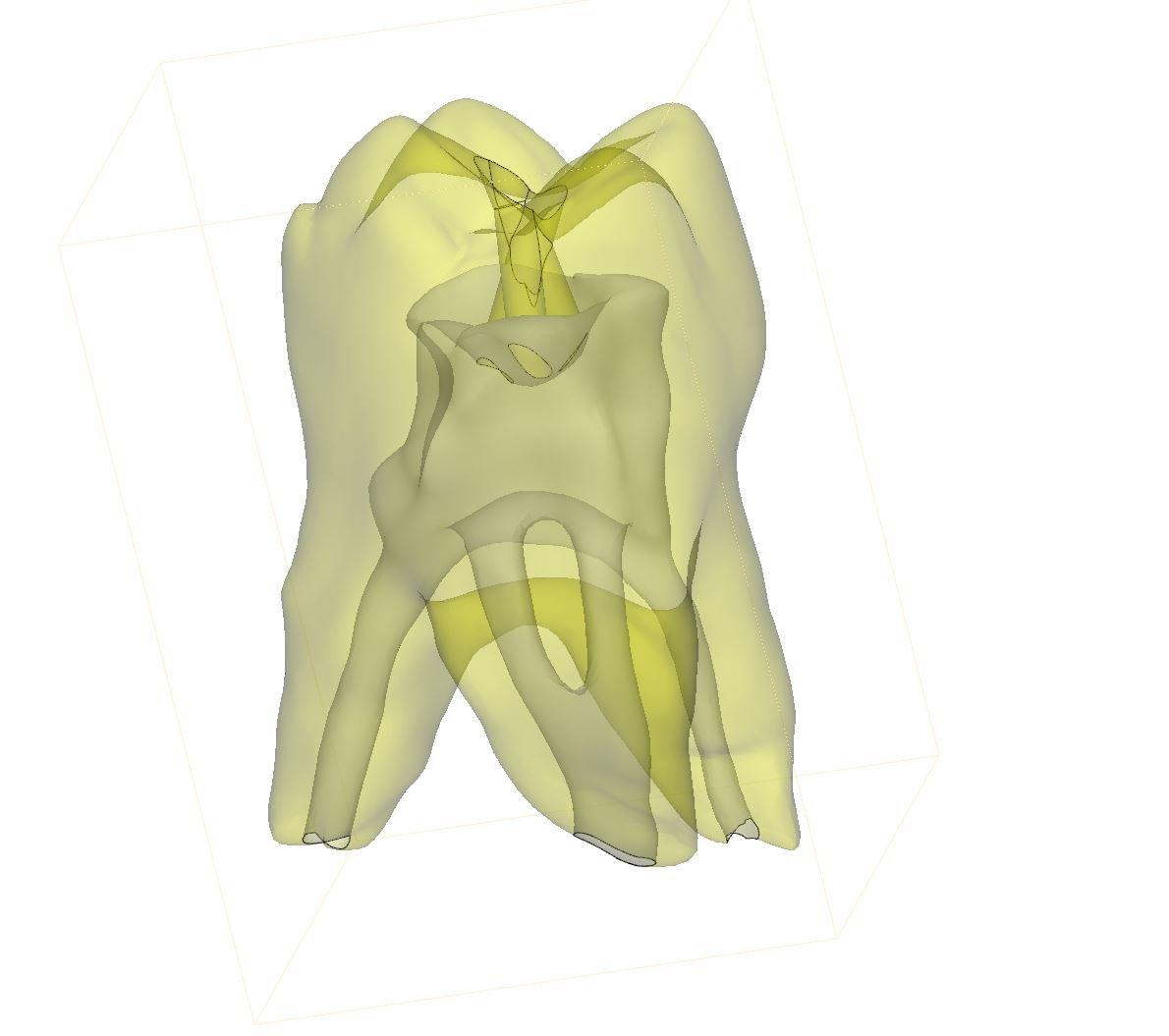 3D printing teaching aids: Screenshot of Materialise Mimics showing single tooth.
