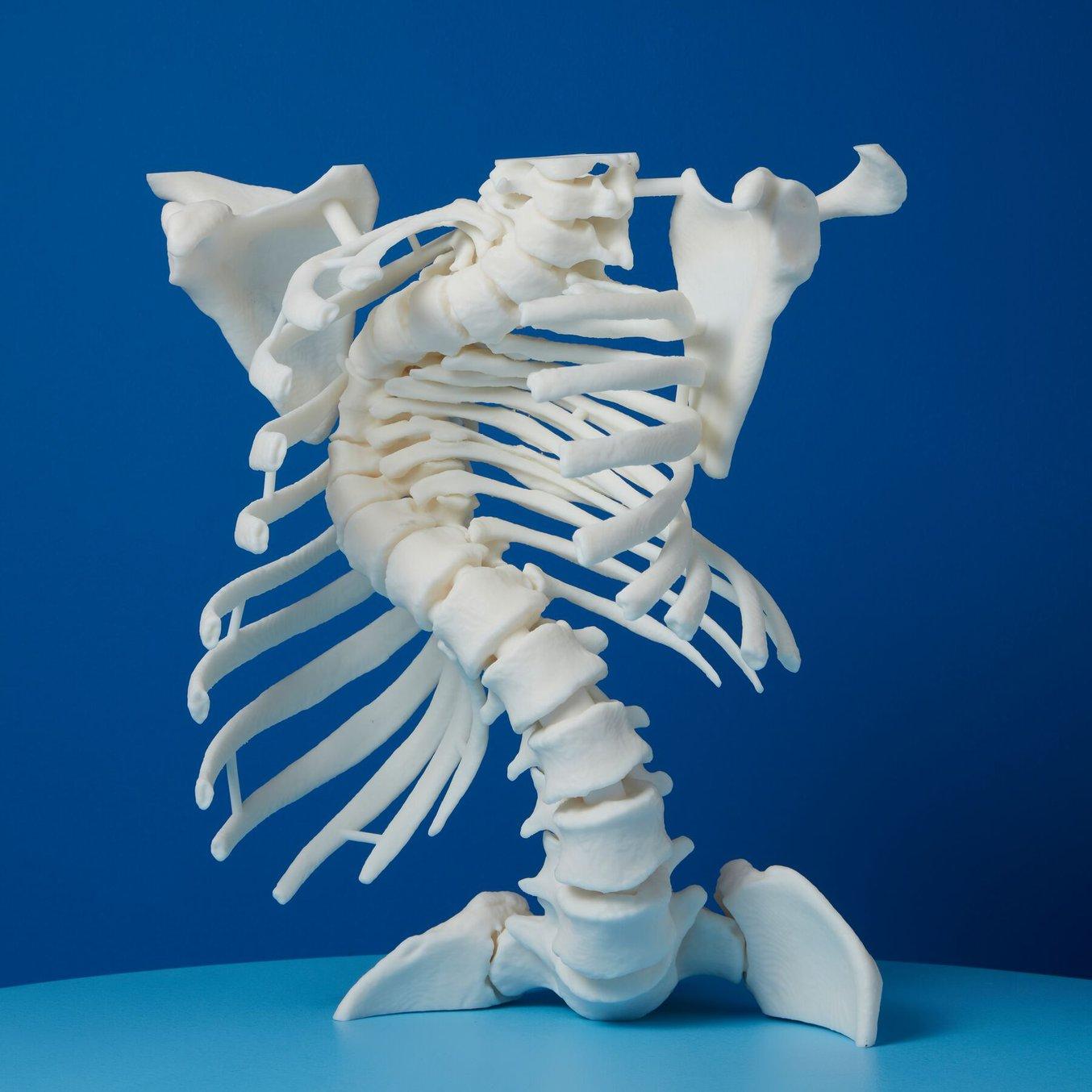 3D Printed Medical Part on a Blue Background