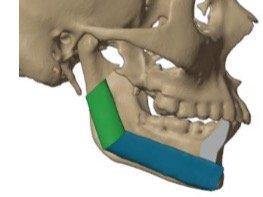 3d model shows the fibula that will replace the part of the mandible removed