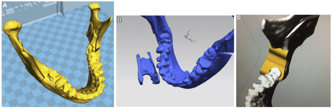 3D mandibular model