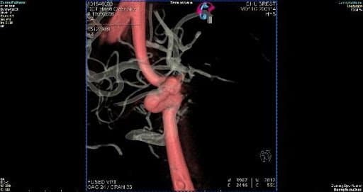 L’anévrisme cérébral est une déformation des parois des vaisseaux sanguins du cerveau.