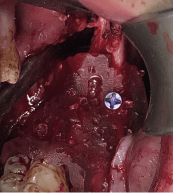 intraoperative view of the guide positioning