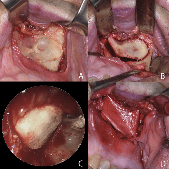 the surgical guide is positioned over the anterior wall of the maxillary sinus