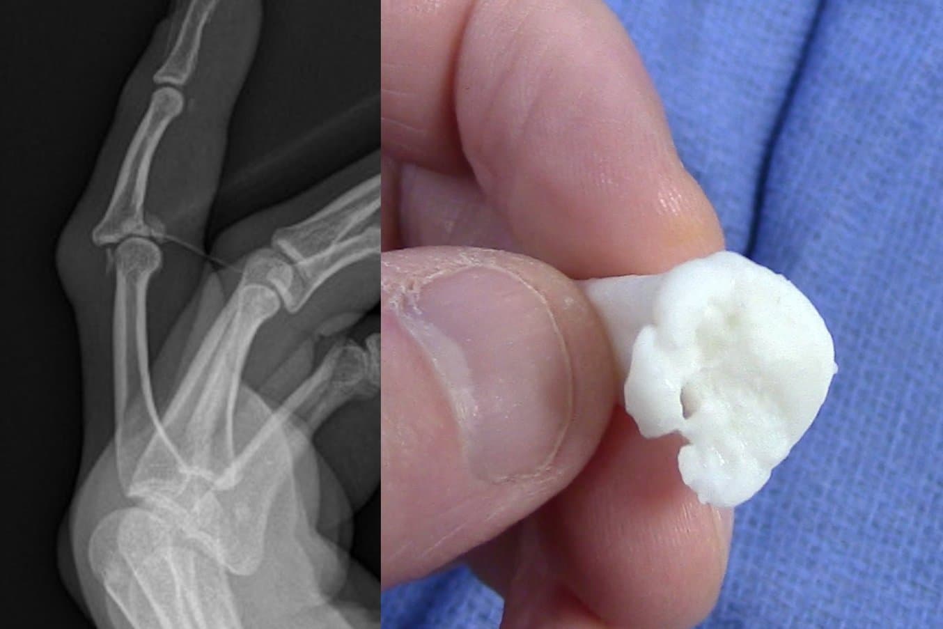 Röntgenaufnahme und 3D-gedrucktes Anatomiemodell eines komplizierten Fingerbruchs