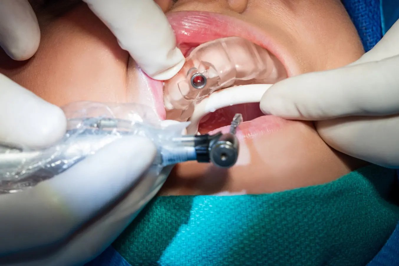 3D-Druck Zahnmedizin