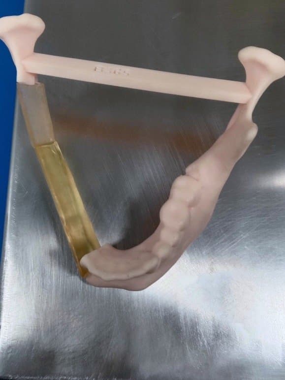 3d printed model of the ameloblastoma treatment