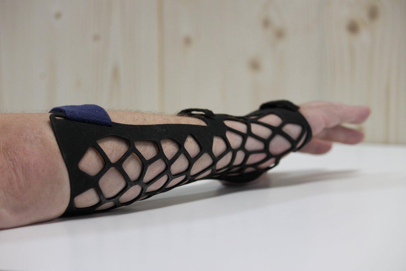 Broken arm supported by airy self-made 3d-printed orthosis