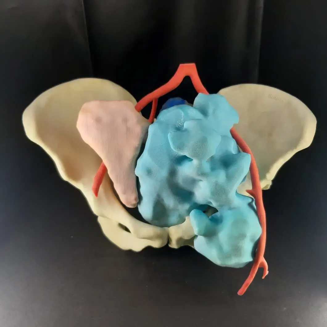 3D tumor model