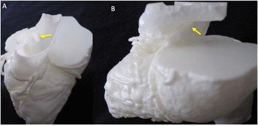 3D printed model of human heart with arrows pointing out arteries