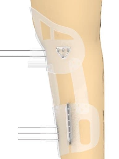 medical drawing of genu varam (bow-leggedness)