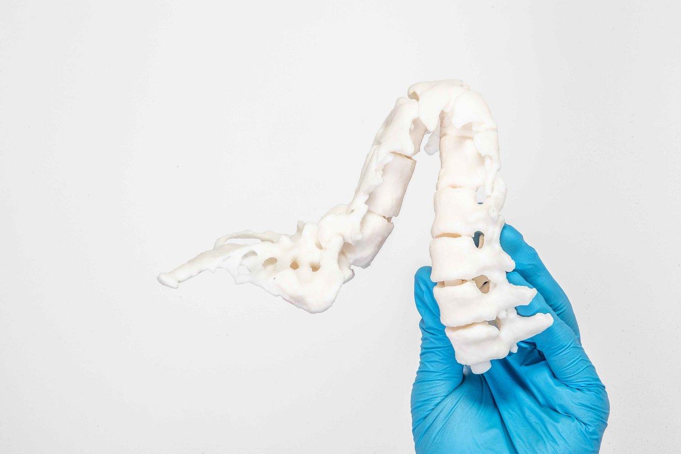 Patient-specific anatomical models: 3d printed spine