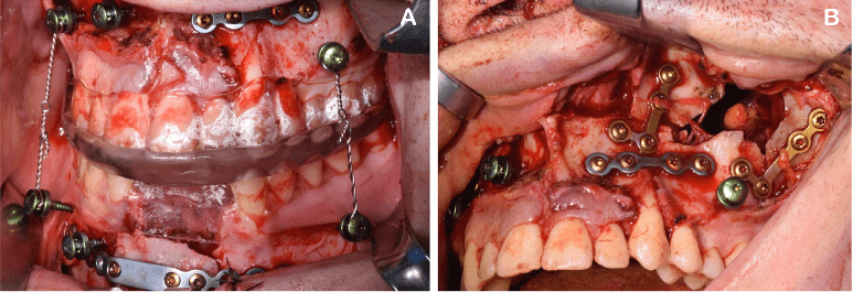Intraoperative application of TCS
