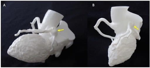 White 3D model of a coronary aneurysm