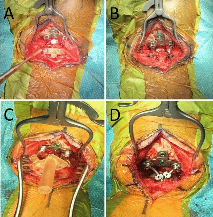 Intraoperative use of drill
