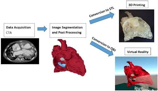Steps involved in the creation of a 3D printed heart model