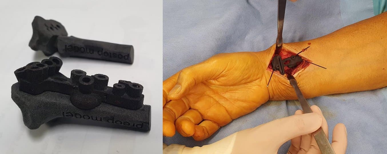 Eine 3D-gedruckte Schablone auf einem präoperativen Modell und während der Operation