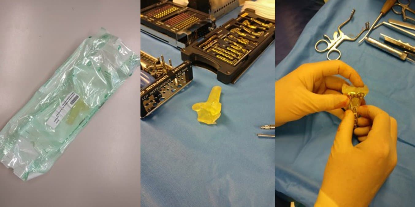 Both SLA and SLS 3D printed anatomical models can be sterilized to be taken into the operating room. This model was used to test the positioning of the metal plate.