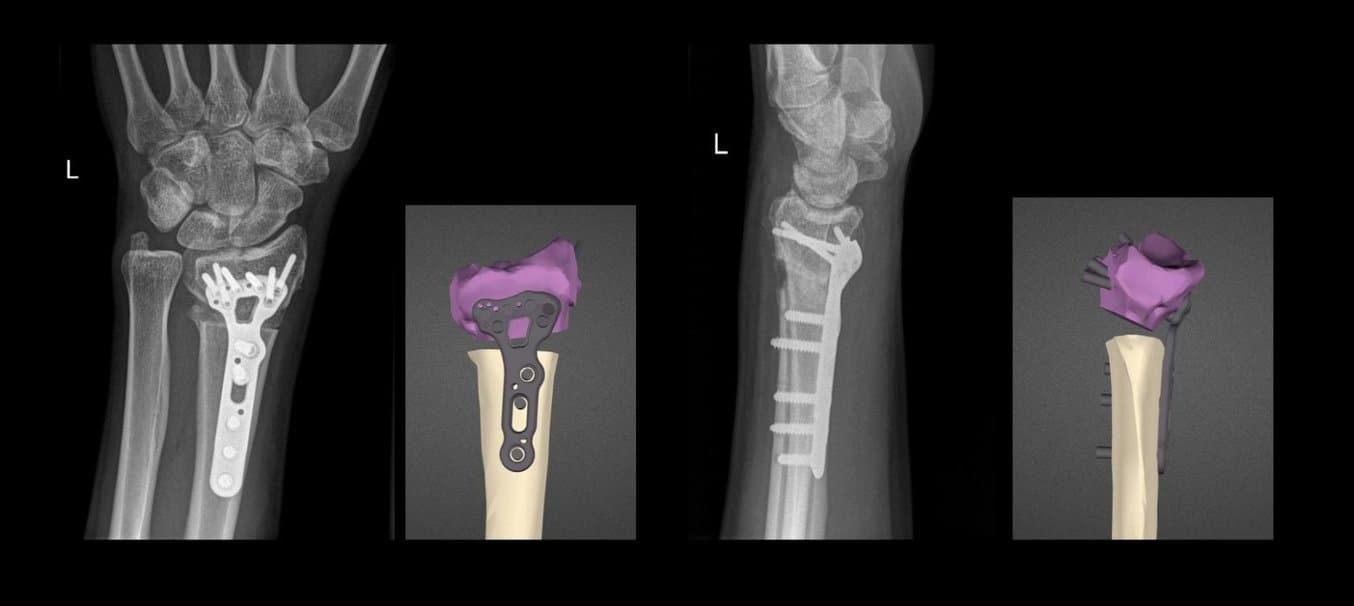 Fehlverheilung eines distalen Speichenbruchs, 3D-Planung des Behandlungsergebnisses und Röntgenergebnisse zwei Wochen nach der OP