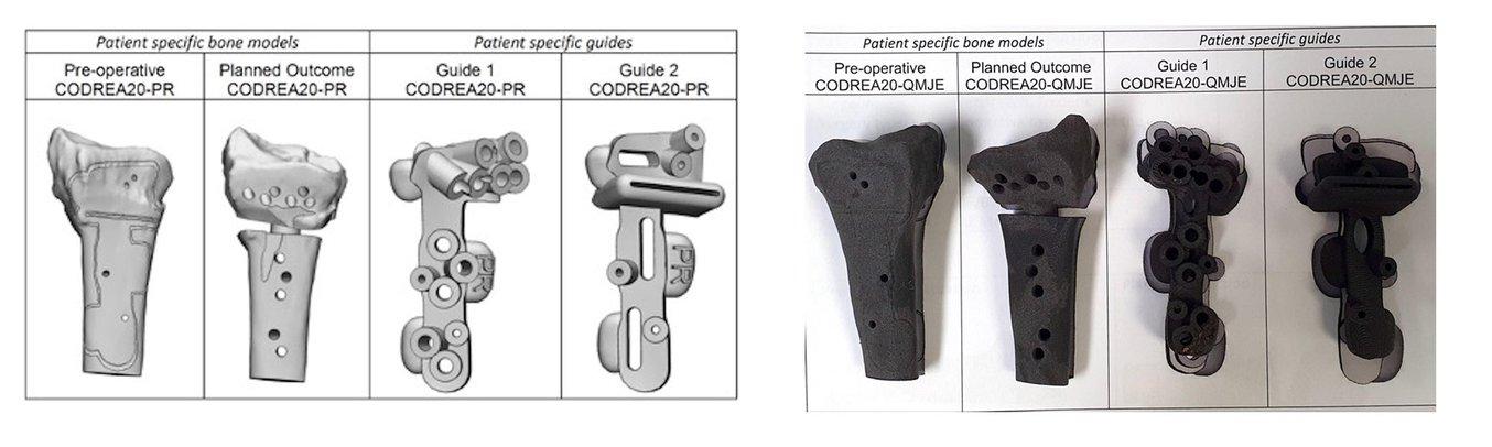 Patient-specific bone models and surgical guides printed in Nylon 12 to treat a distal radius malunion.