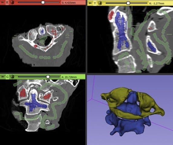 C1 and C2 vertebral body