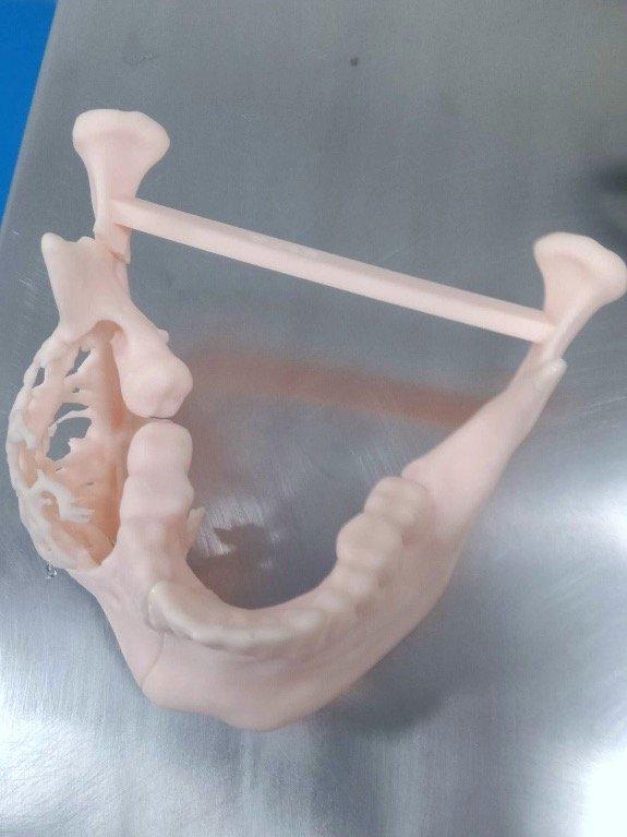 3d printed model of the ameloblastoma