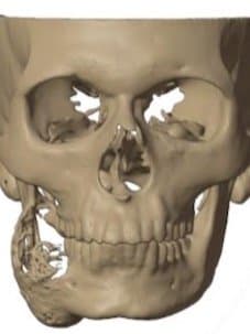 Front view of the ameloblastoma on a digital model
