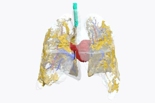 Look Inside the Lungs of a Coronavirus Patient With The Help of This 3D Model