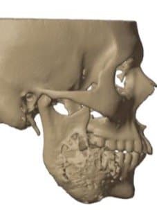 side view of the ameloblastoma model