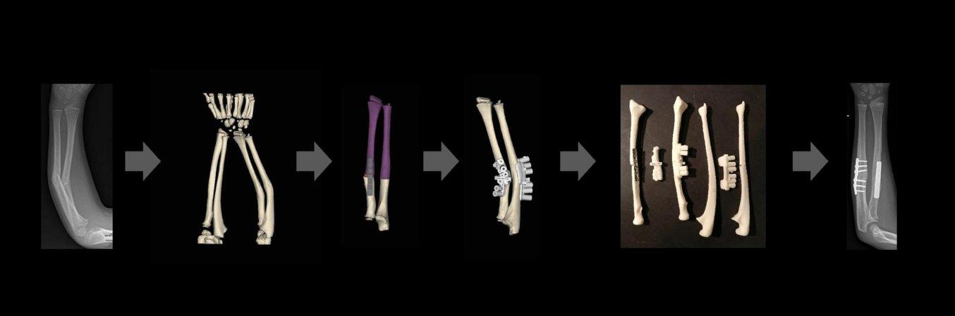 workflow from broken bone to fracture treatment with 3d printed surgical guides
