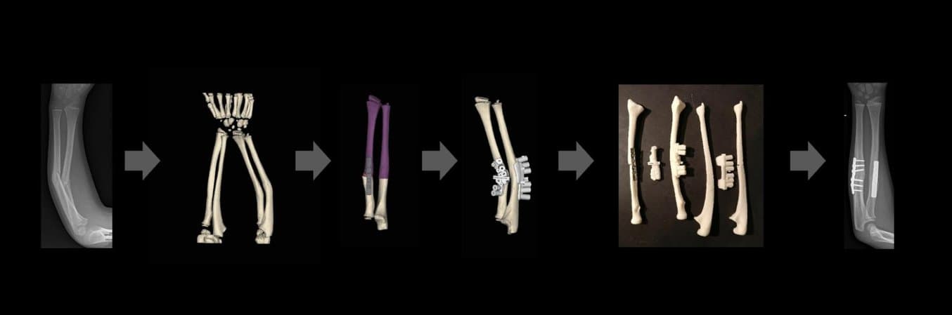 Der Arbeitsablauf vom Knochenbruch bis zur Frakturbehandlung mit 3D-gedruckten Chirurgieschablonen