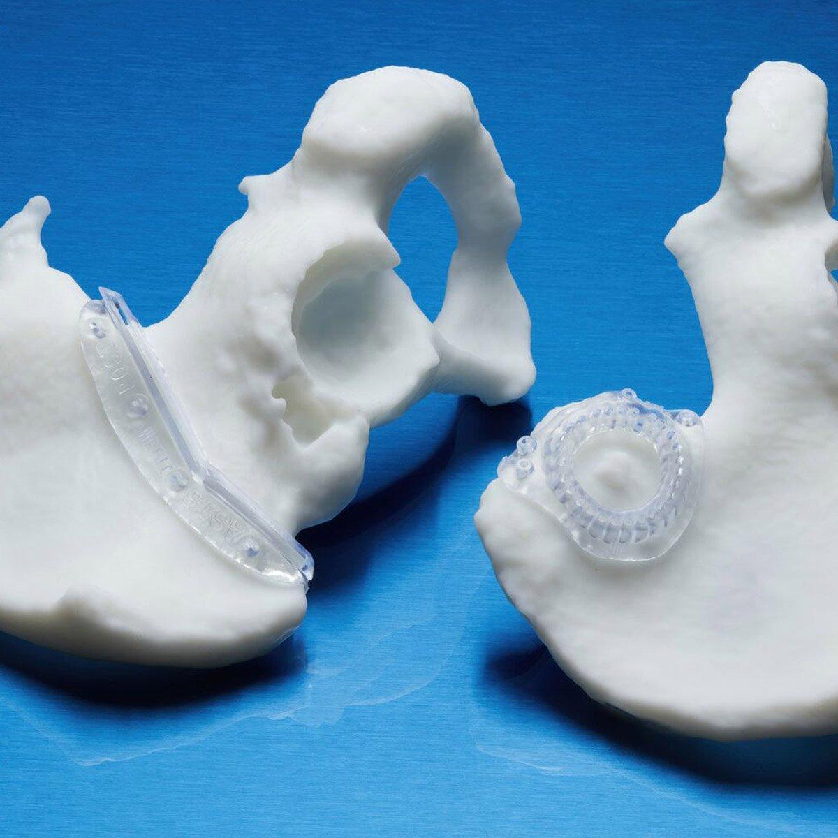 3D-gedruckte Bohrschablonen aus BioMed Durable Resin