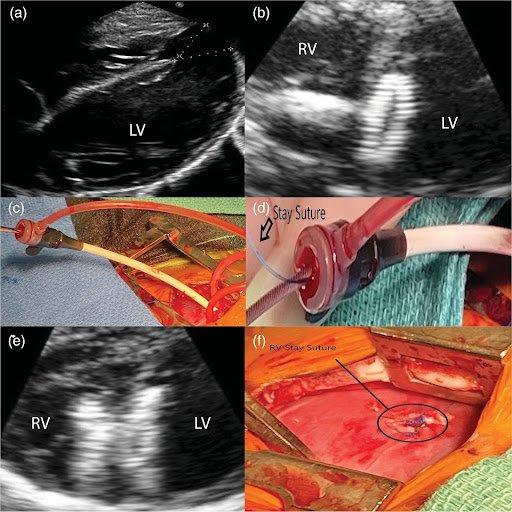 Echocardiograms and images of sutures and delivery systems