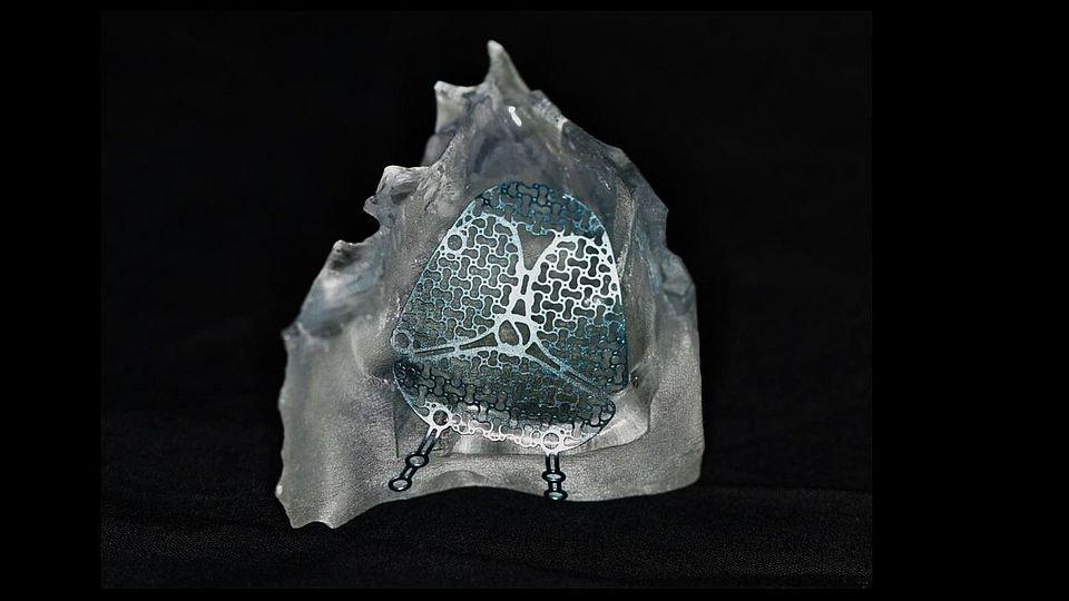 Modelo anatómico impreso en 3D con un implante de titanio predoblado adaptado al paciente
