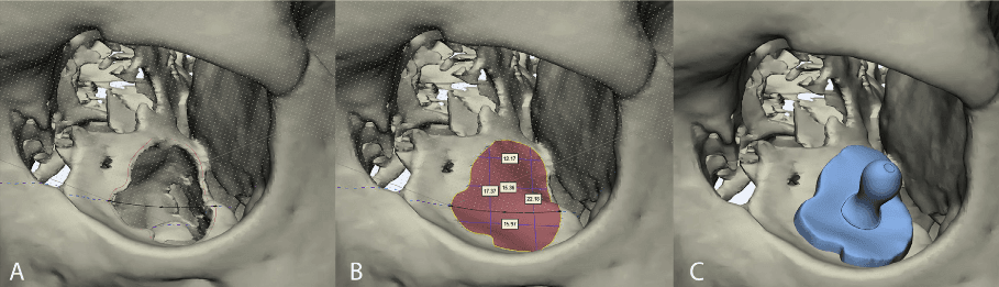Virtual surgical planning in orbital floor reconstruction