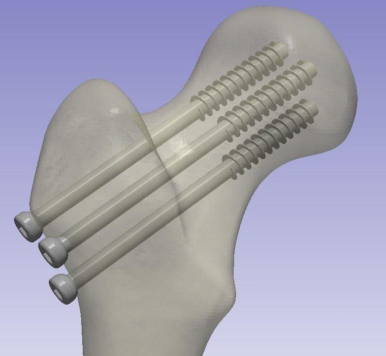 3D model of a bone with three screws in it
