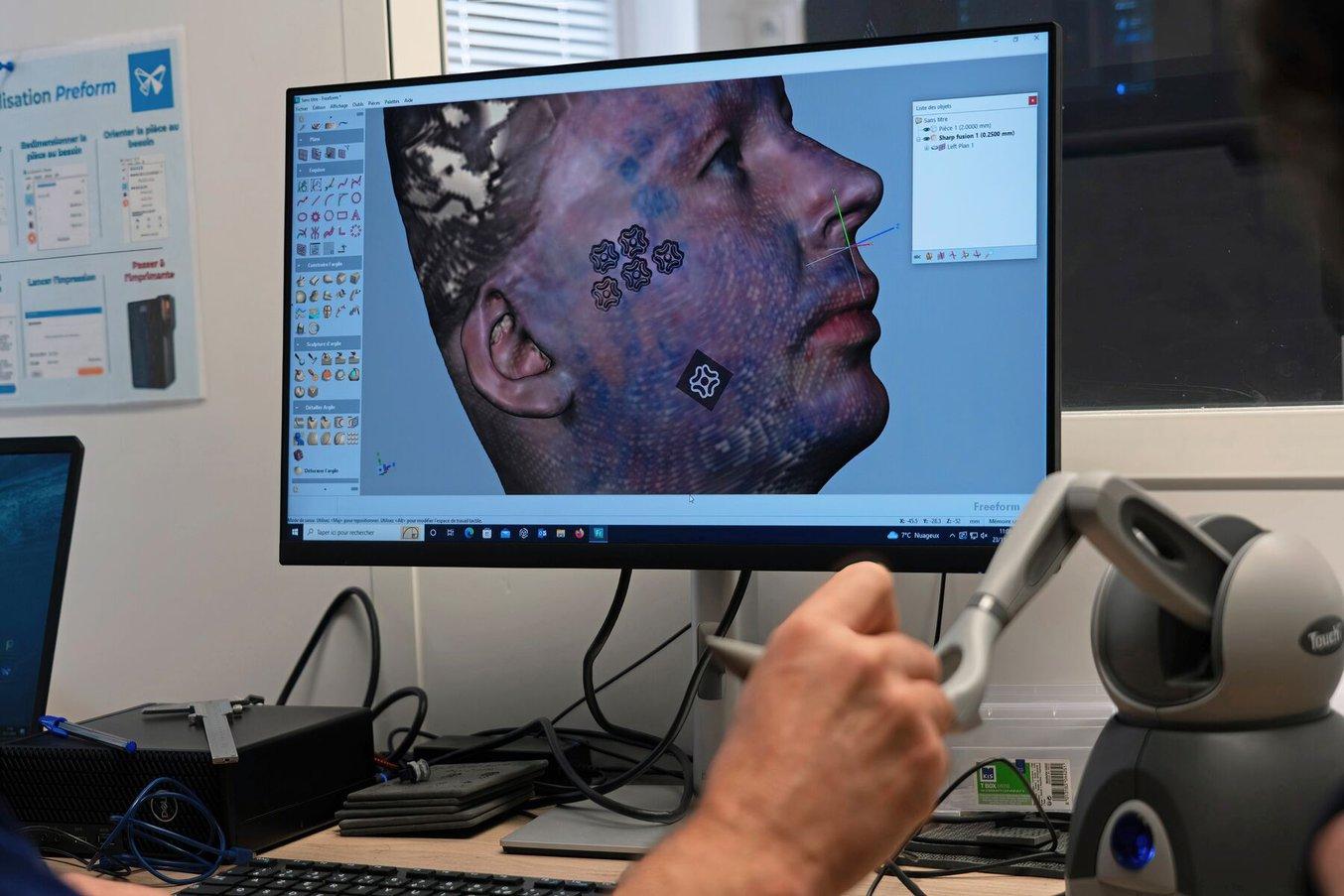 The orthoprosthetist uses a digital pen to precisely add the targeted reliefs to the design before creating a 3D printable model.